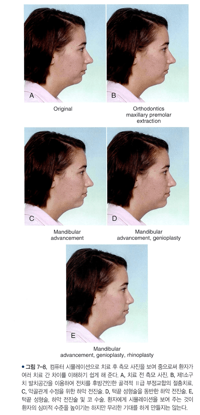 절충교정과 턱교정수술에 따른 안모 변화 시뮬레이션 비교