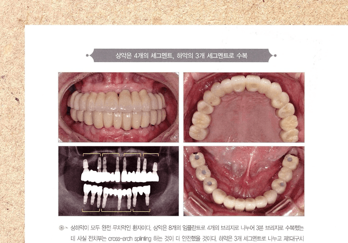 완전 무치악 수복 및 세그먼트 수복 증례 — 상악 4구간, 하악 3구간 분할