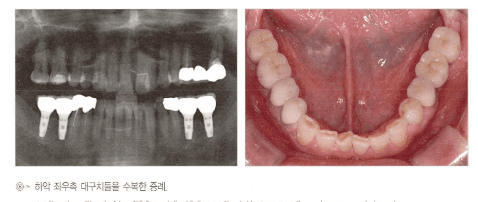 상악 우측 대구치부 임플란트 식립 임상 증례 — 파노라마와 구강 내 사진