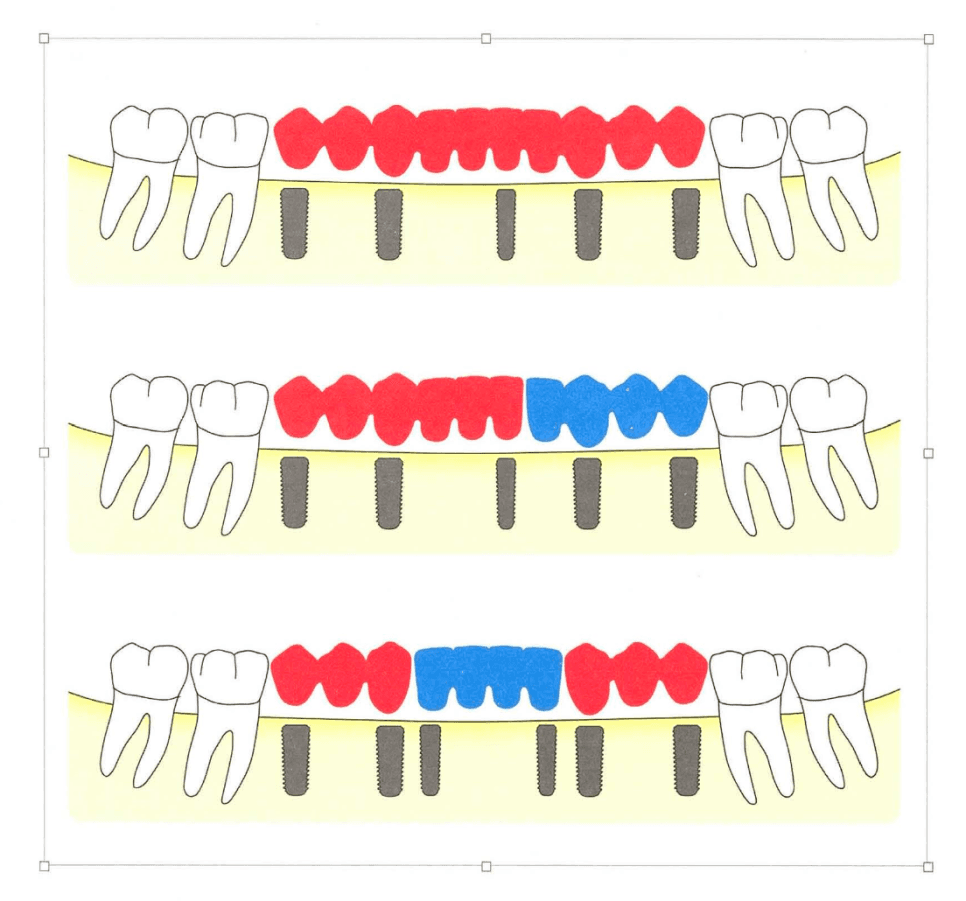 대구치 부위 공간에 따른 임플란트 1개 vs 2개 배치
