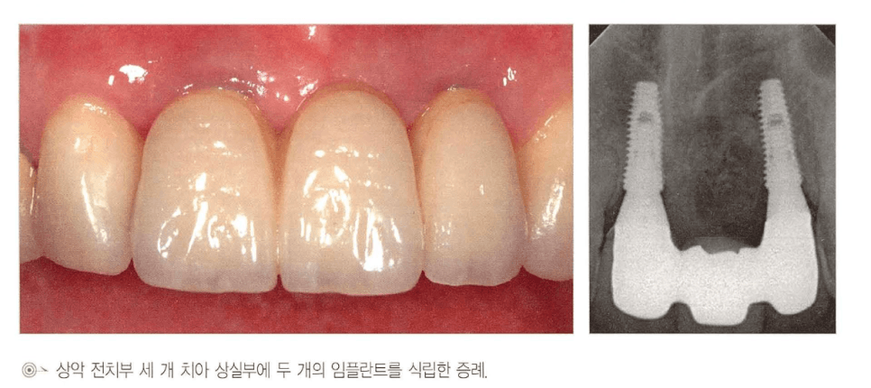 상악 전치부 3개 상실부에 임플란트 2개를 식립하고 중간을 pontic으로 처리한 임상 증례