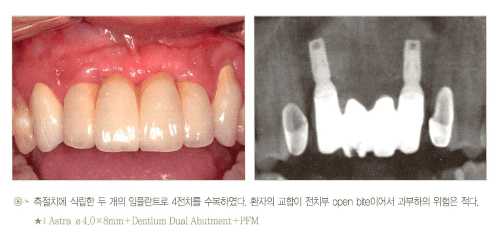 측절치에 식립된 임플란트 2개로 전치부 open bite 환자의 4전치를 수복한 증례