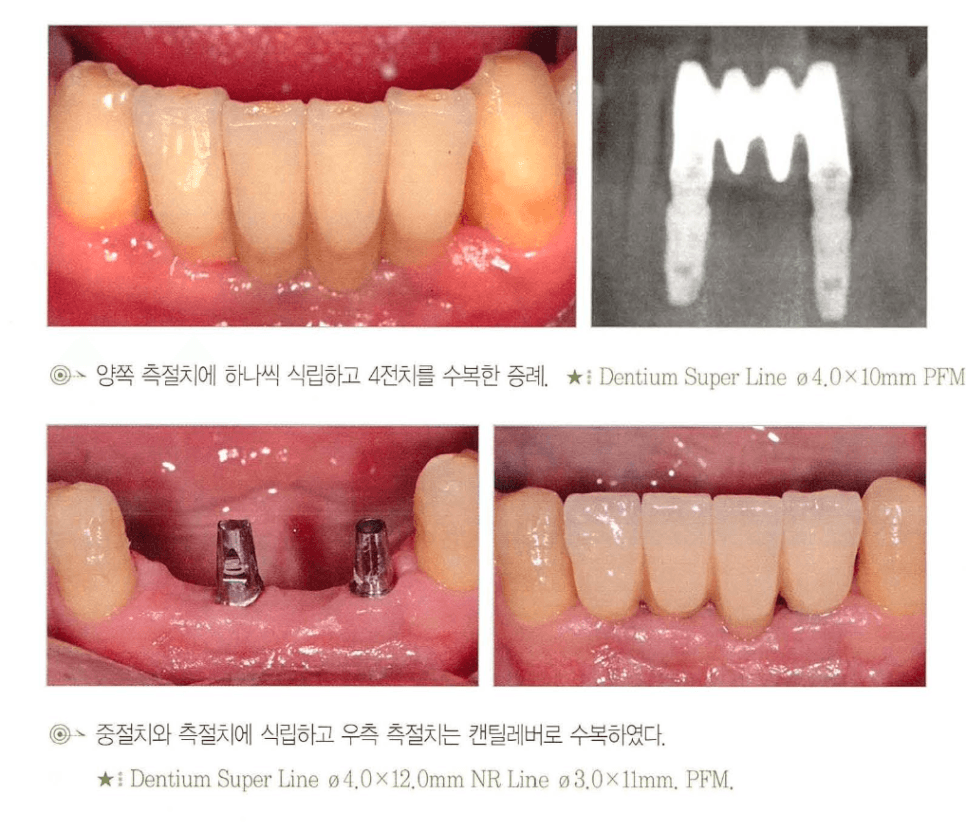 하악 전치부 4전치 수복의 두 가지 설계 — 측절치 각 1개 식립 vs 중절치+측절치 식립 후 캔틸레버