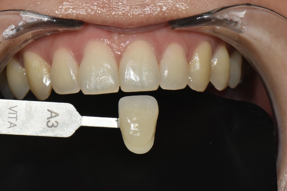 ホワイトニング前