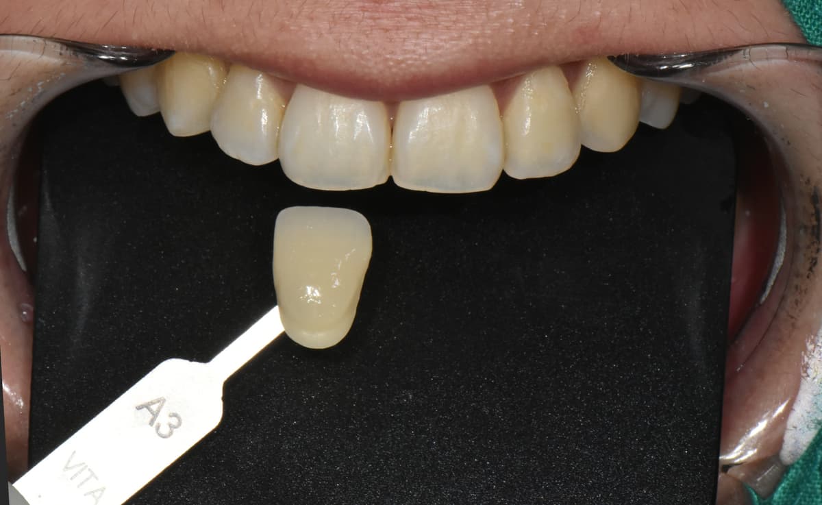 ホワイトニング前