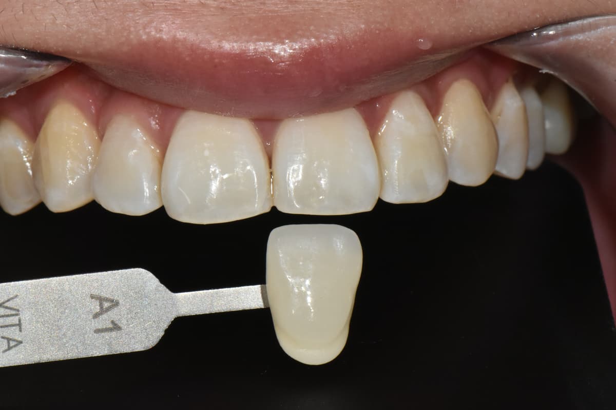 ホワイトニング後