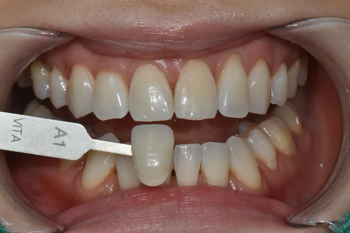 ホワイトニング後