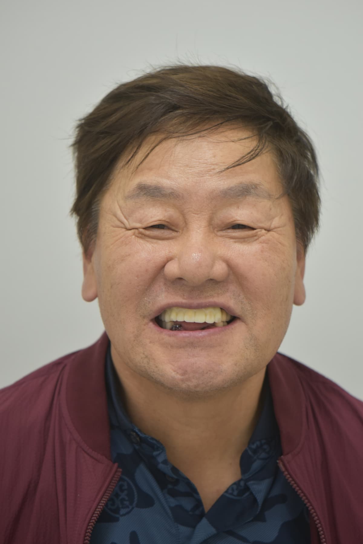 After same-day teeth