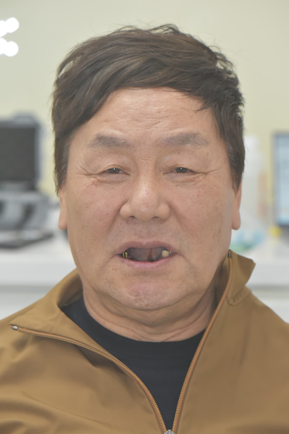 Before same-day teeth