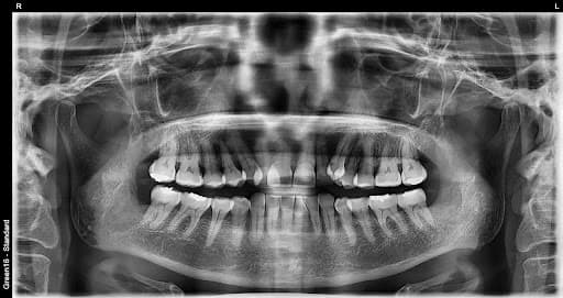 完全阻生智齿 - 拔牙后