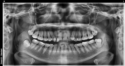 完全阻生智齿 - 拔牙前
