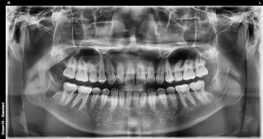 正常智齿 - 拔牙后