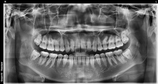 正常智齿 - 拔牙前