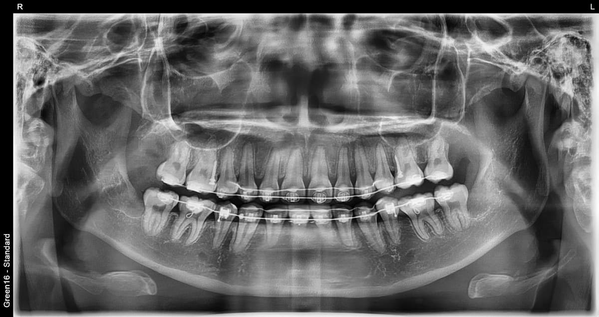 正畸中的智齿 - 拔牙后