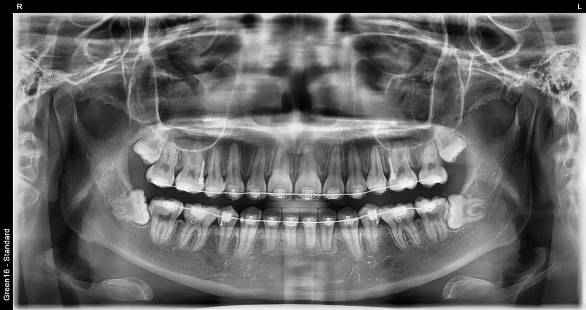 正畸中的智齿 - 拔牙前