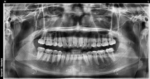 部分阻生智齿 - 拔牙后