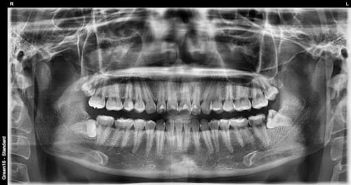 部分阻生智齿 - 拔牙前