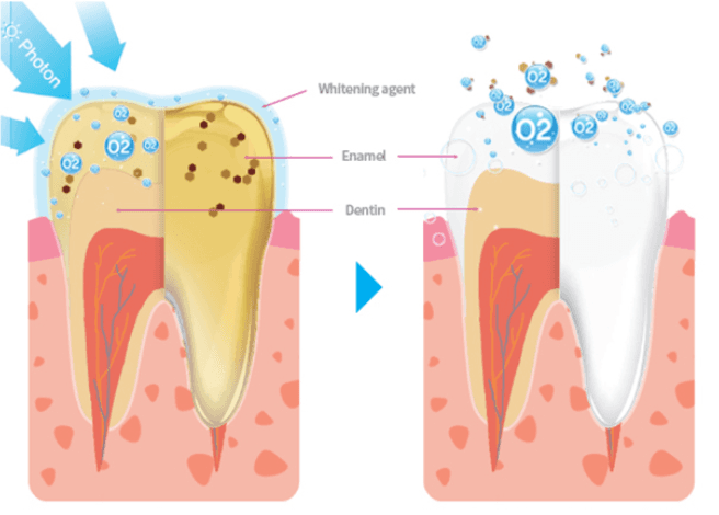 過酸化水素ホワイトニングの原理