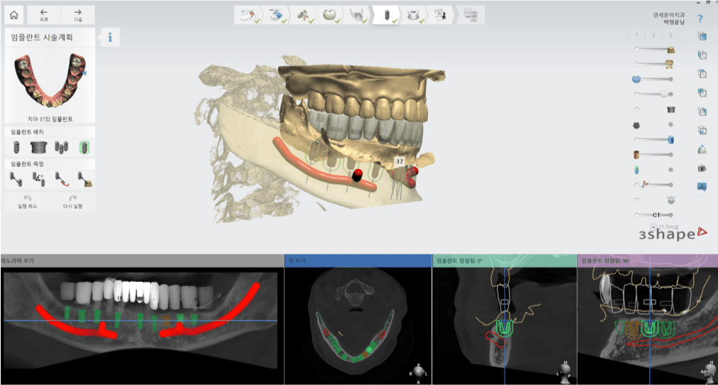 3D Digital Guide Surgery