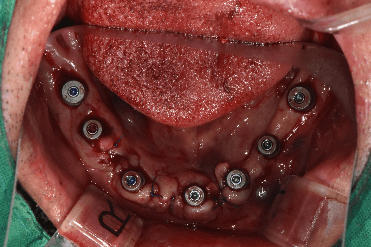 Flapless Implant Surgery